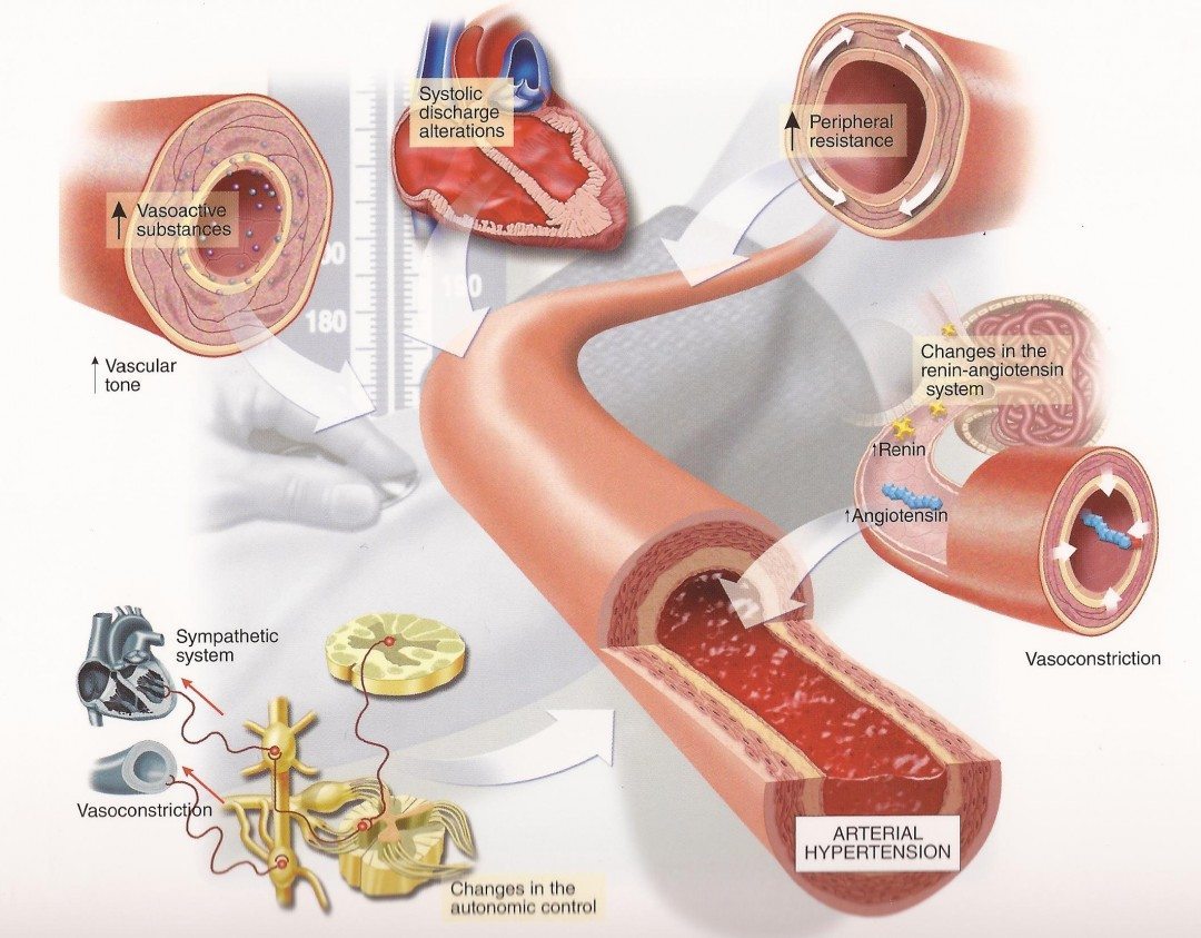 secondary-hypertension-discovering-the-underlying-cause-aafp